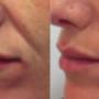 Rejuvenecimiento facial