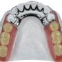 Prótesis Dental Metálica