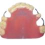 Prótesis dental Parcial