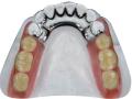 Prótesis dental Removible Metálica