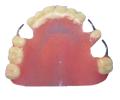 Prótesis dental Removible Parcial