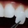 Carillas veneers