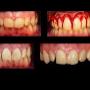 Cirugía Periodontal
