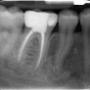 Endodoncia