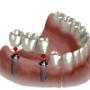 Implantes