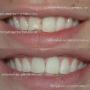 veneers_2