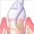 TRATAMIENTO PERIODONTITIS