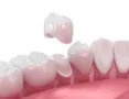 Coronas dentales libres de metal en SVG Clínica Dental