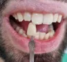 Blanqueamiento dental en SVG Clínica Dental Vitacura