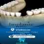 Implante Dental en Metropolitana de Santiago